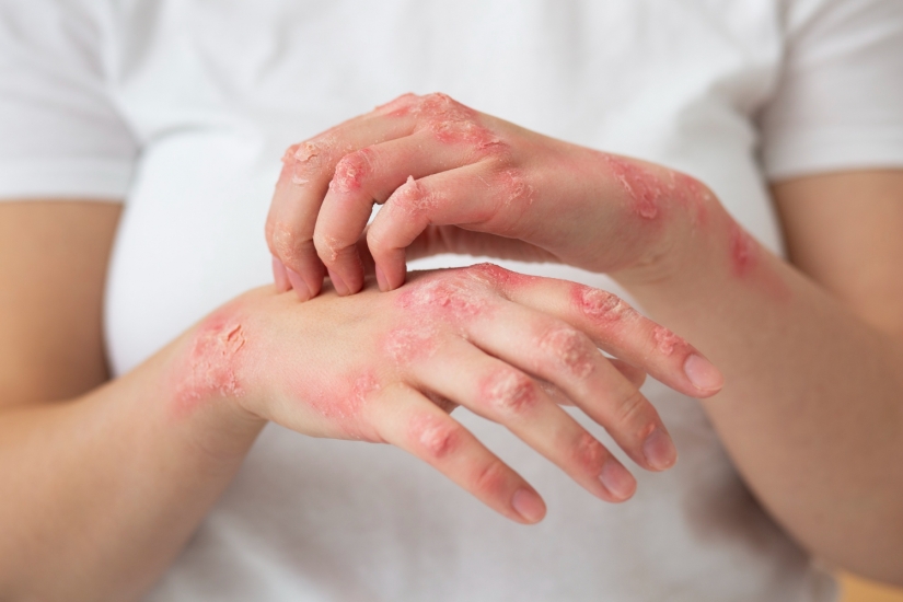 Ministry of Public Health Reports Decline in Monkeypox Cases in 2025 but Continues Surveillance of High-Risk Groups and Imported Strains