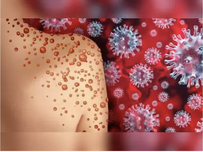 Thailand Confirms First Case of New Mpox Virus Strain in Asia